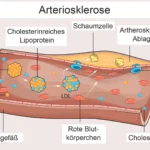 triglyceride zu hoch symptome