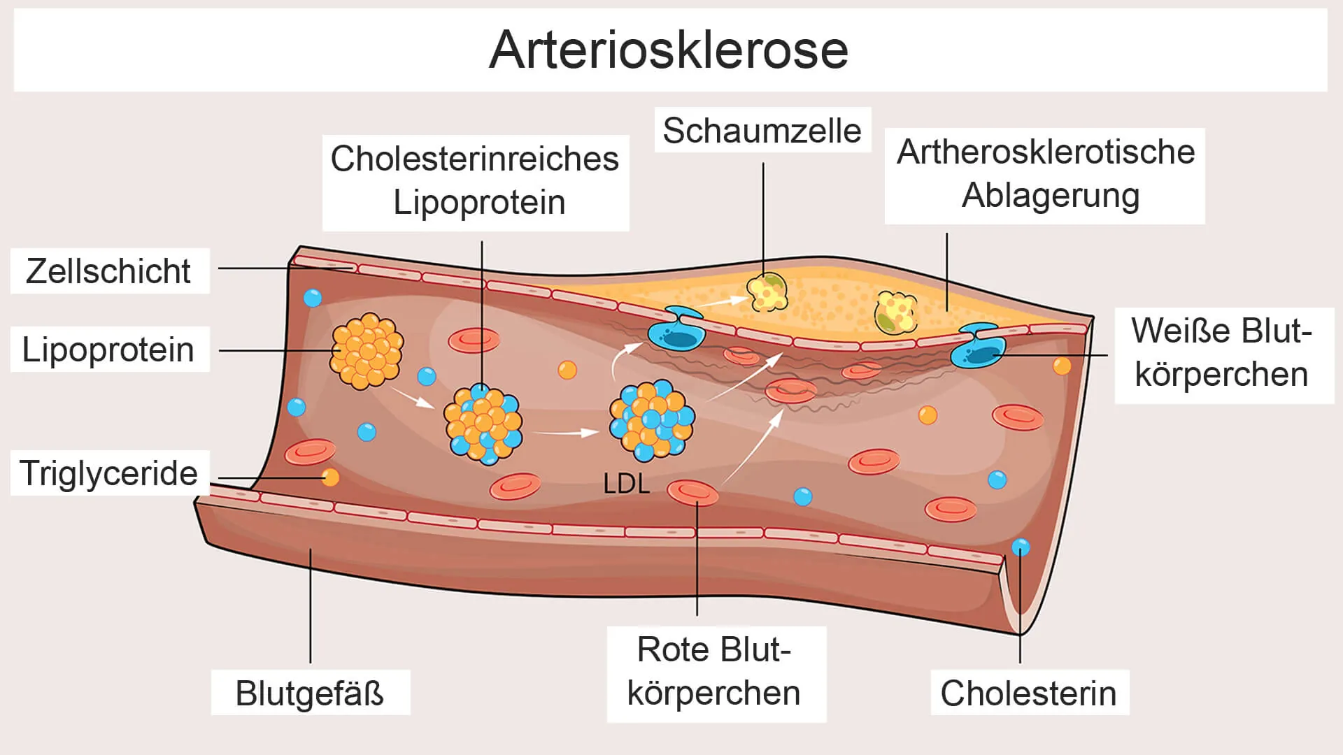 triglyceride zu hoch symptome